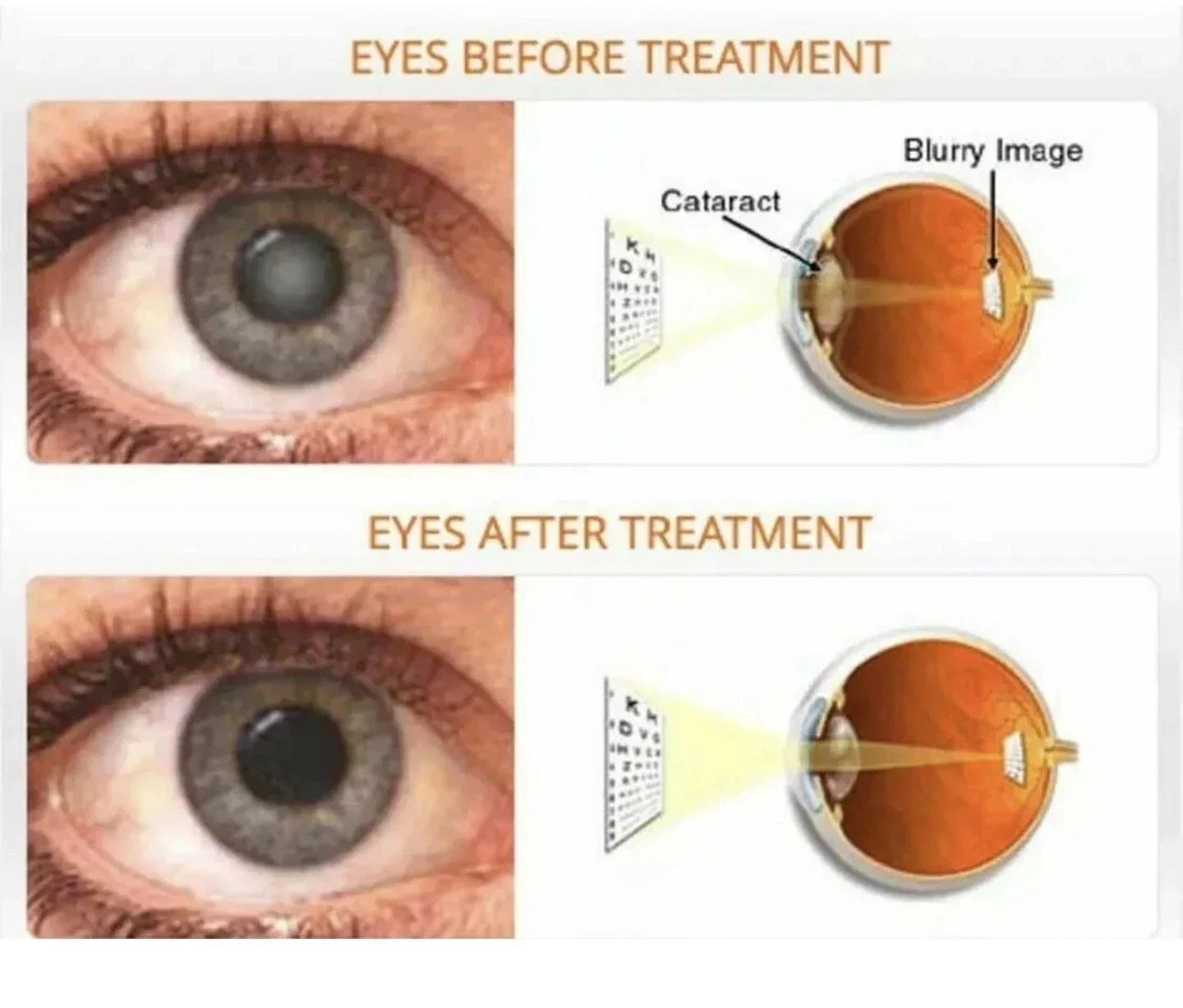 Eye Drops Isotine Plus Ayurvedic Eye Care Glaucoma Sore Eye Clear Vision 3X10ml thumbnail
